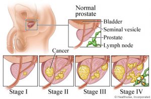 Stages-of-Prostate-Cancer